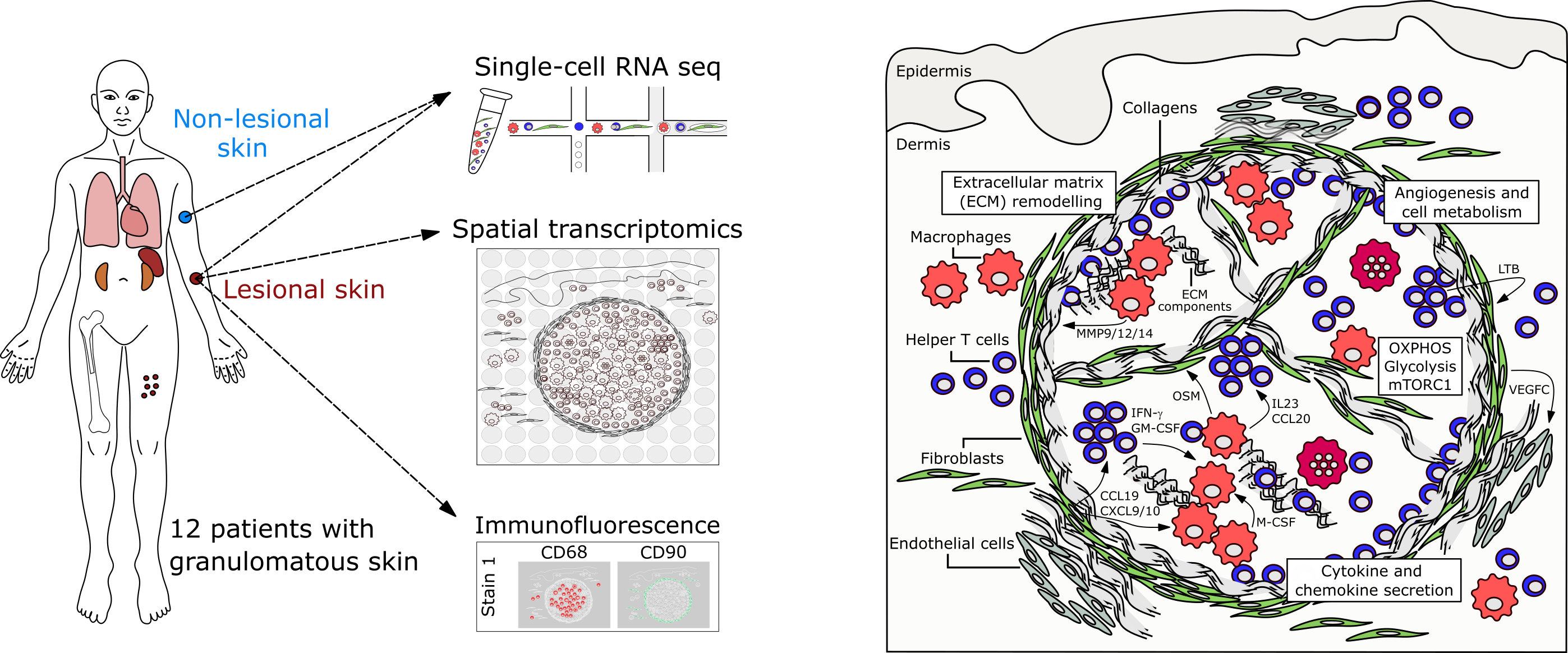 Single-cell and spatial transcriptomics reveal aberrant lymphoid developmental programs driving granuloma formation